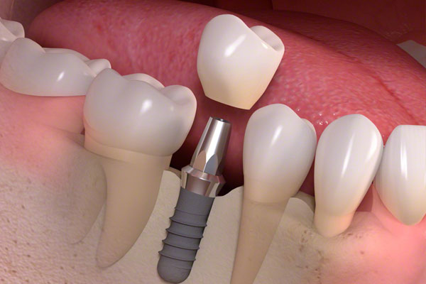 Implantes Dentales En Guadalajara